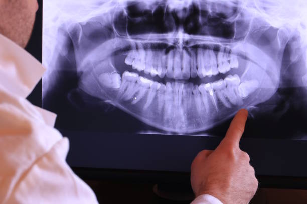 Best Emergency Tooth Extraction in Berly, MO