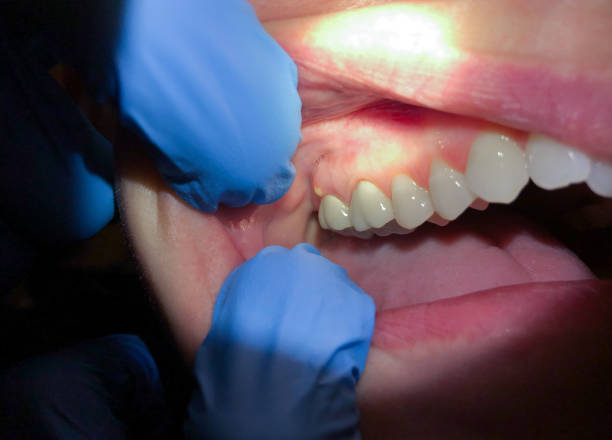 Best Emergency Root Canal Treatment in Berly, MO